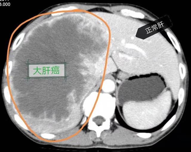 乙肝研究新进展：HBV-RNA可早期预测由慢乙肝引起的肝癌 ――研究中使用了仁度生物的设备和试剂