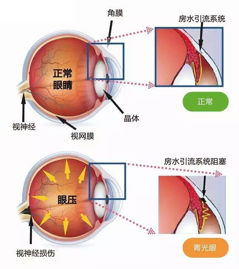 参天公司宣布青光眼引流器系统上市许可申请获得CMDE受理