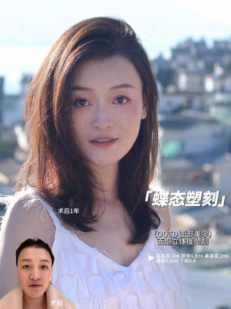 铁打的高毛利，流水的“医美茅”：胶原蛋白捧出山西女首富，玻尿酸富豪们身家大跌